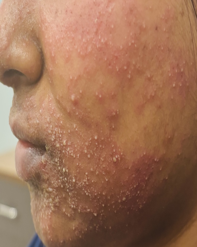 Before Acne Scar Revision